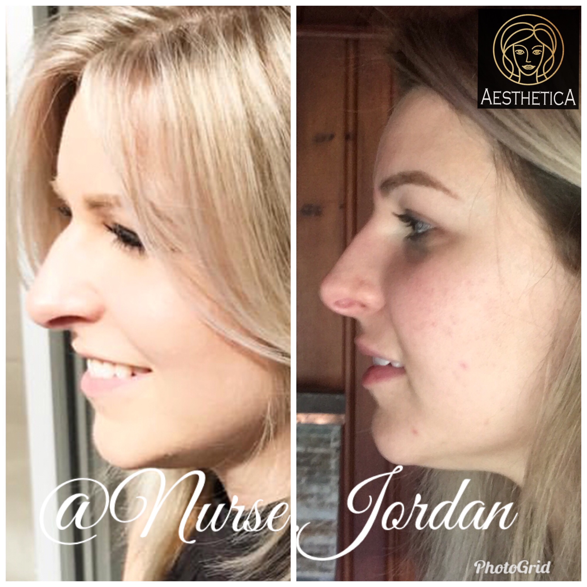 Liquid Nose Job Before amp After Non Surgical Nose Job Swansea